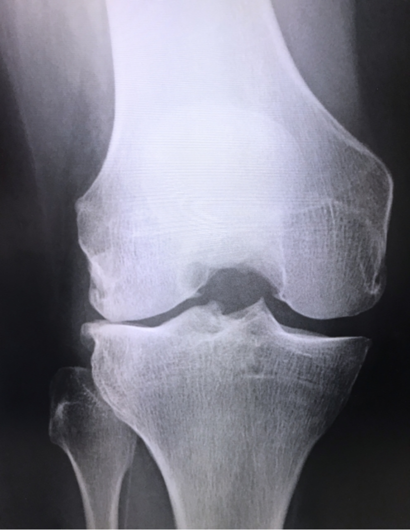 骨の変形による膝痛